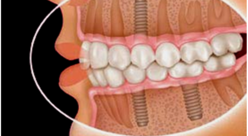 DENTAL IMPLANT IS OUR TREATMENT OF CHOICE