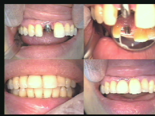 Anterior Dental Implant Replacing a Missed Upper Right Central Incisor.