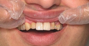 the final zirconia crowns after cementation